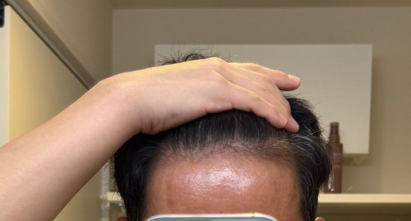 薬を再開する直前、2026年10月の頭頂部（手で髪を上げた状態）